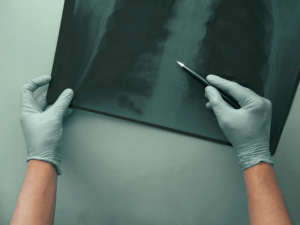 Lekarz analizuje zdjęcie RTG i wskazuje zmiany na obrazie
