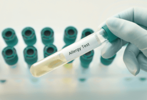 Testy alergiczne - lekarz trzyma próbkę do diagnostyki alergii w laboratorium