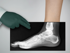 Lekarz analizuje RTG stopy i stawu skokowego, wskazując zmiany na obrazie