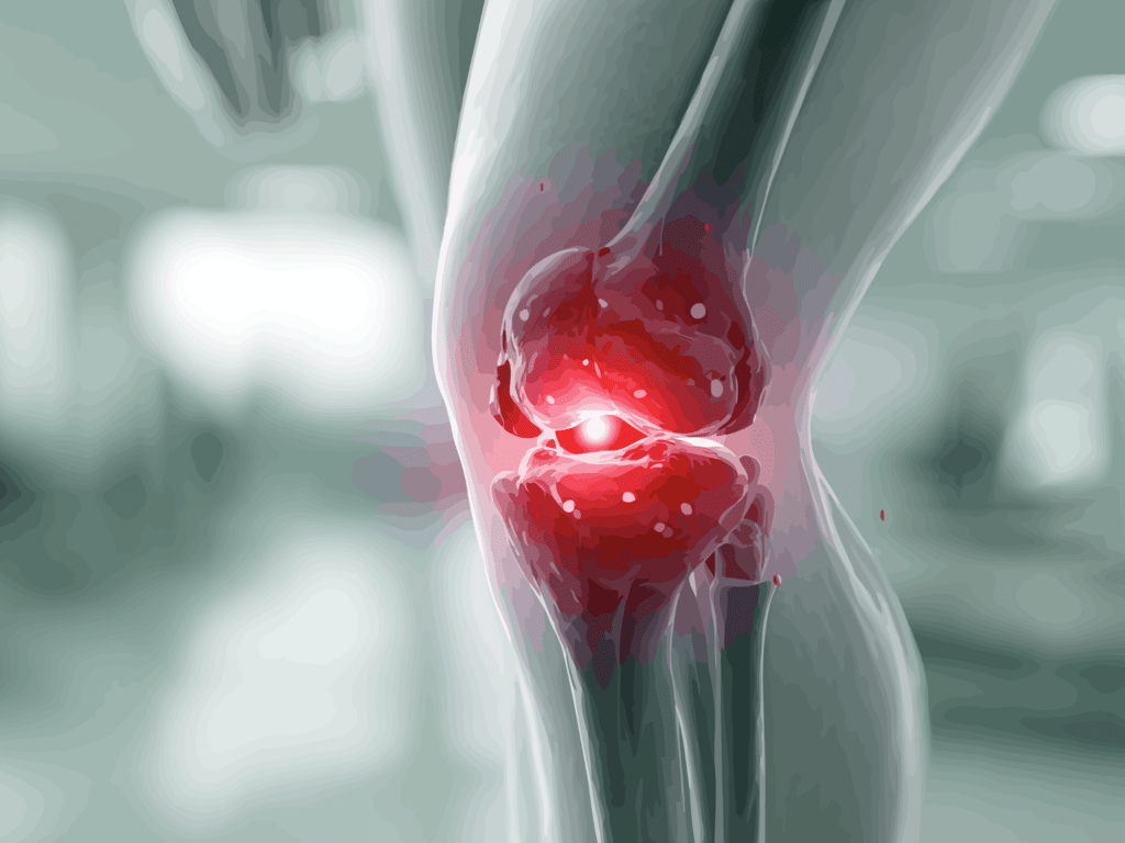 Terapia osoczem bogatopłytkowym PRP Angel system wspomagająca regenerację stawu kolanowego