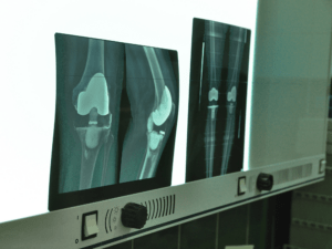 zdjęcie RTG przedstawiające implant pełnej endoprotezy kolana